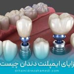 مزایای ایمپلنت دندان