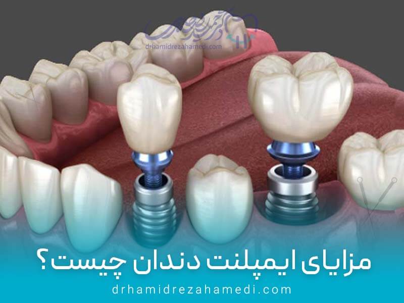 مزایای ایمپلنت دندان