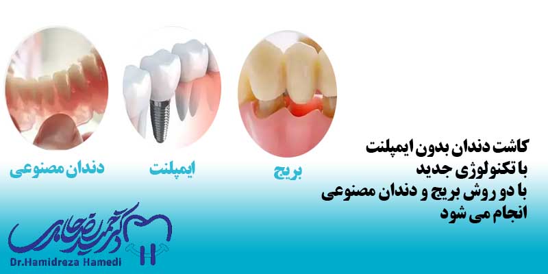 روش کاشت دندان بدون ایمپلنت