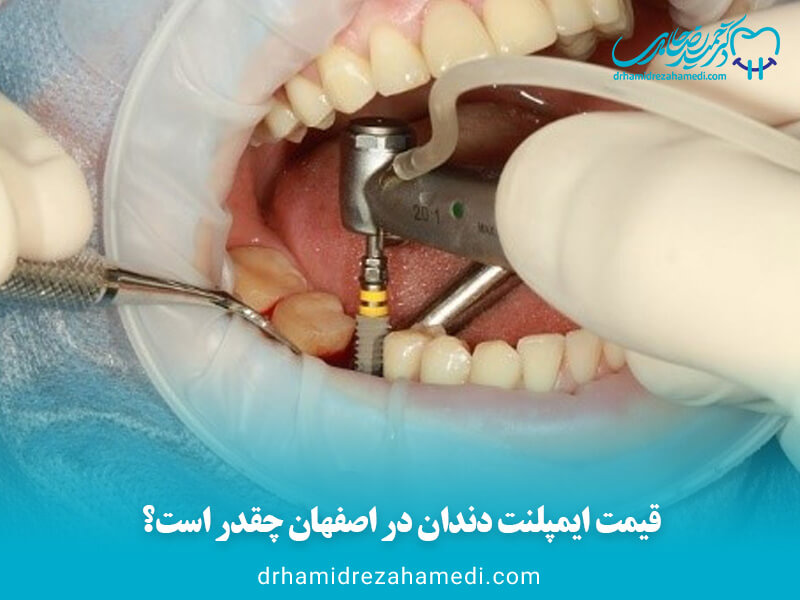 قیمت ایمپلنت دندان در اصفهان