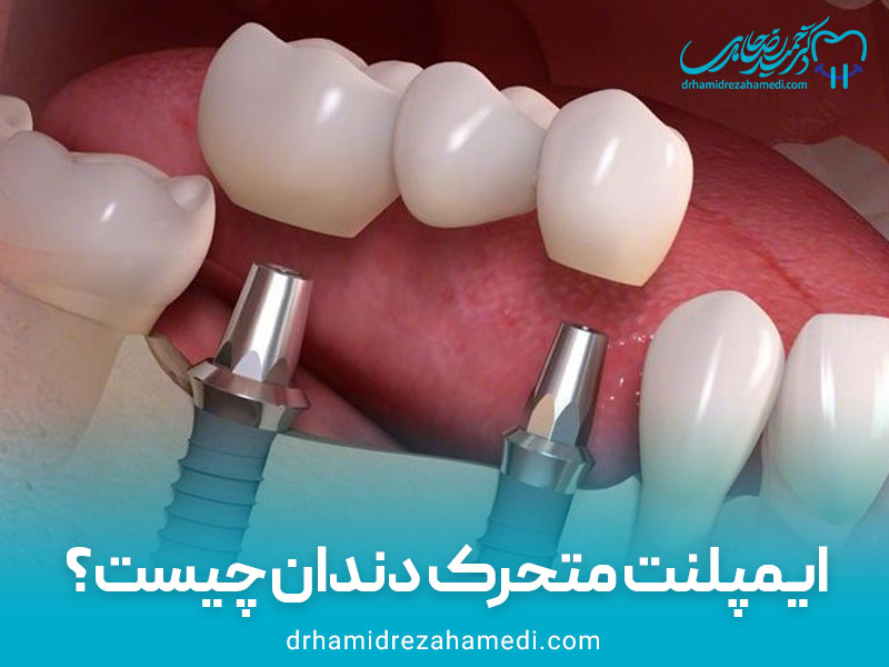 ایمپلنت متحرک دندان