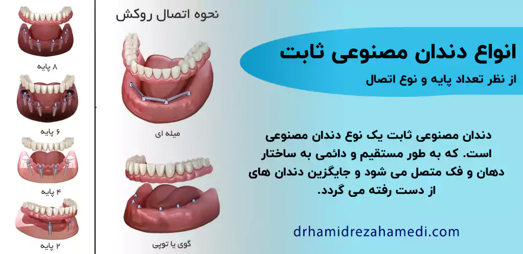 انواع کاشت دندان مصنوعی ثابت