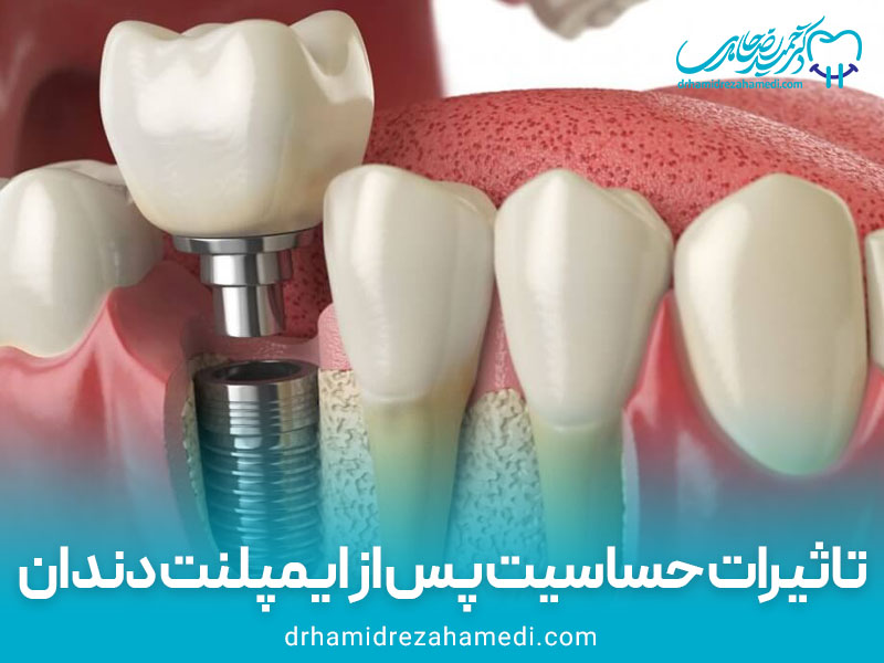 تاثیرات حساسیت پس از ایمپلنت دندان