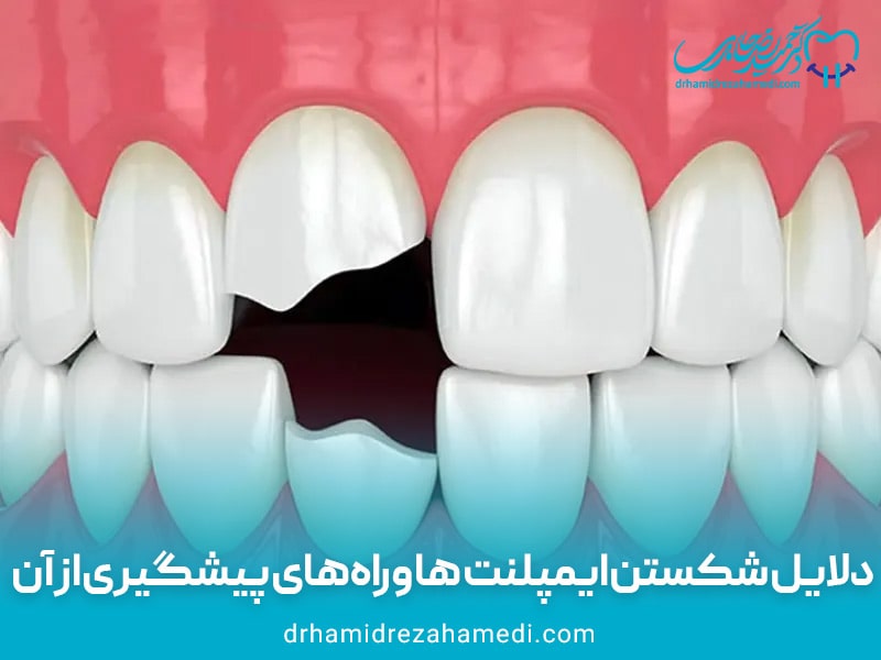 دلایل شکستن ایمپلنت ها و راه‌های پیشگیری از آن